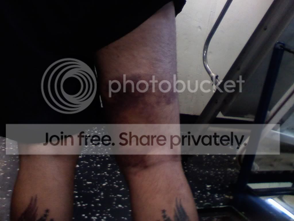Torn hamstring photo by stubbsc photobucket
